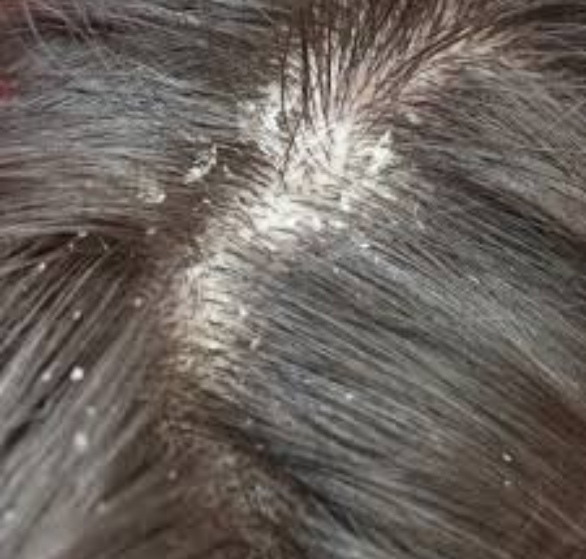 scalp peel.png